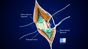 AZZCCPP - Pudendal Neuralgia - Drawing of the steps of transgluteal pudendal neurolysis by Professor Roger Robert