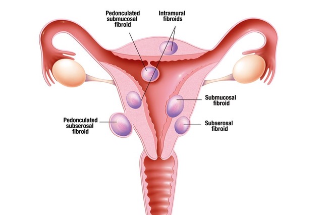 Ovarian Remnant Syndrome