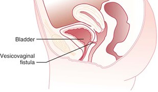 vesicocolic fistula