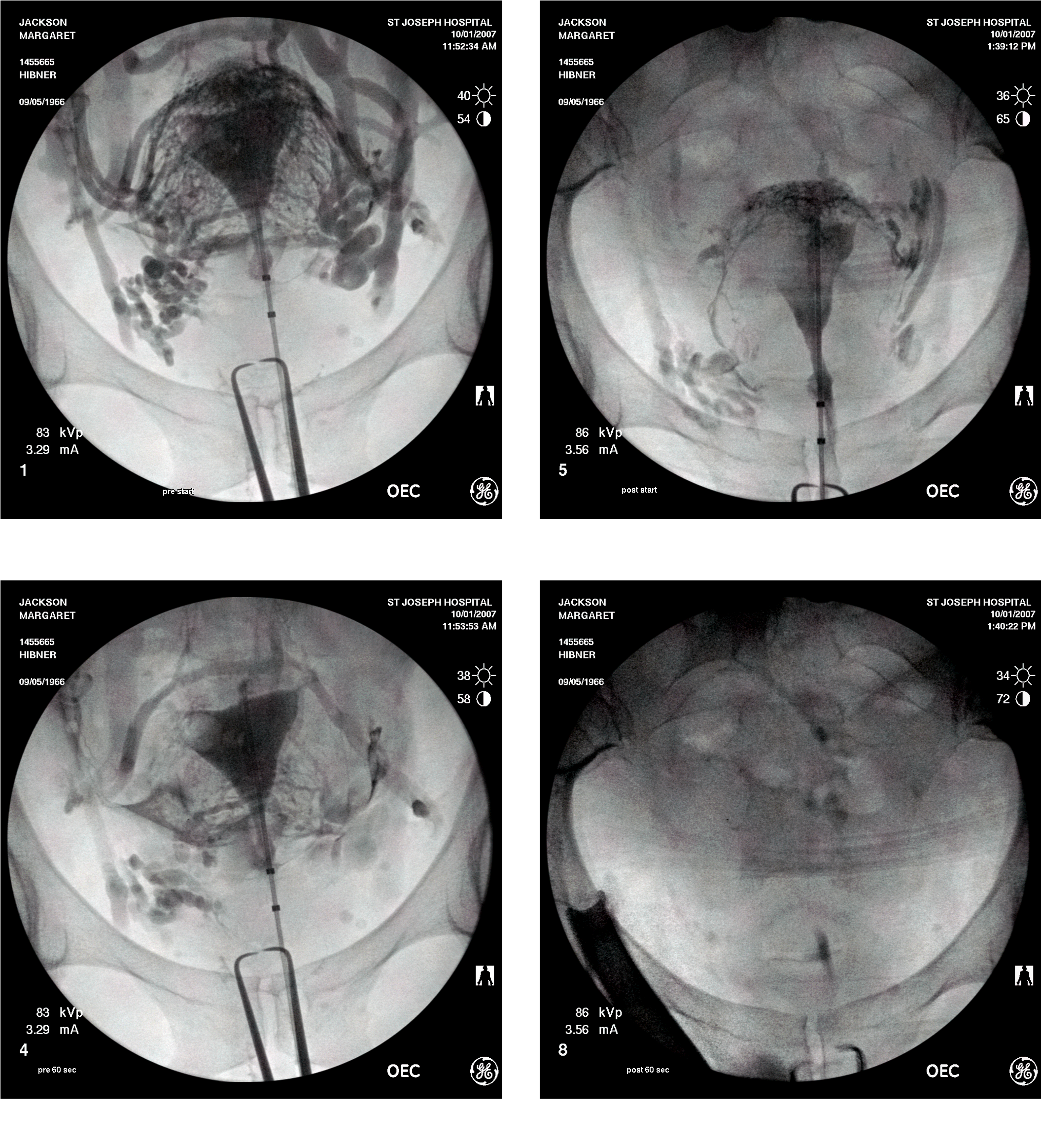 Pelvic congestion syndrome