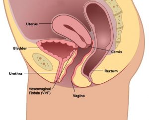 Rectovaginal Fistula