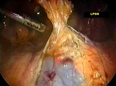 Laparoscopic Presacral Neurectomy