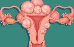 uterine Fibroids, Pelvic Pain Experts, AZCCPP