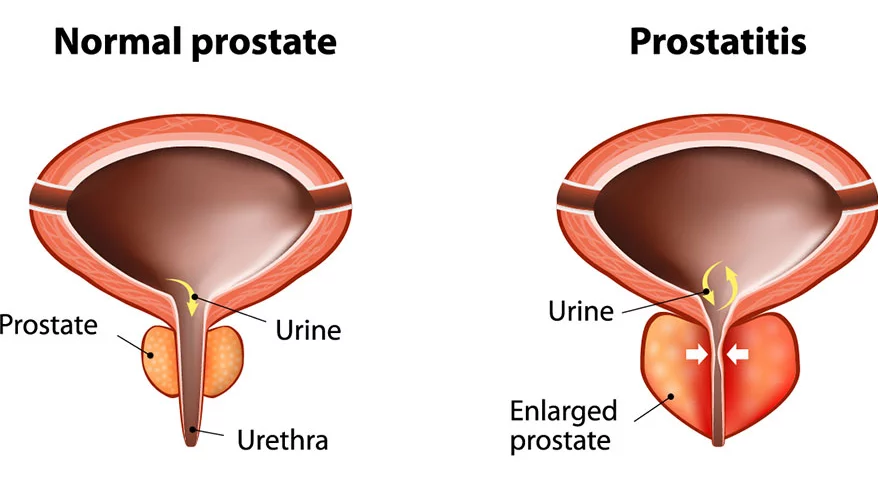 prostatitis