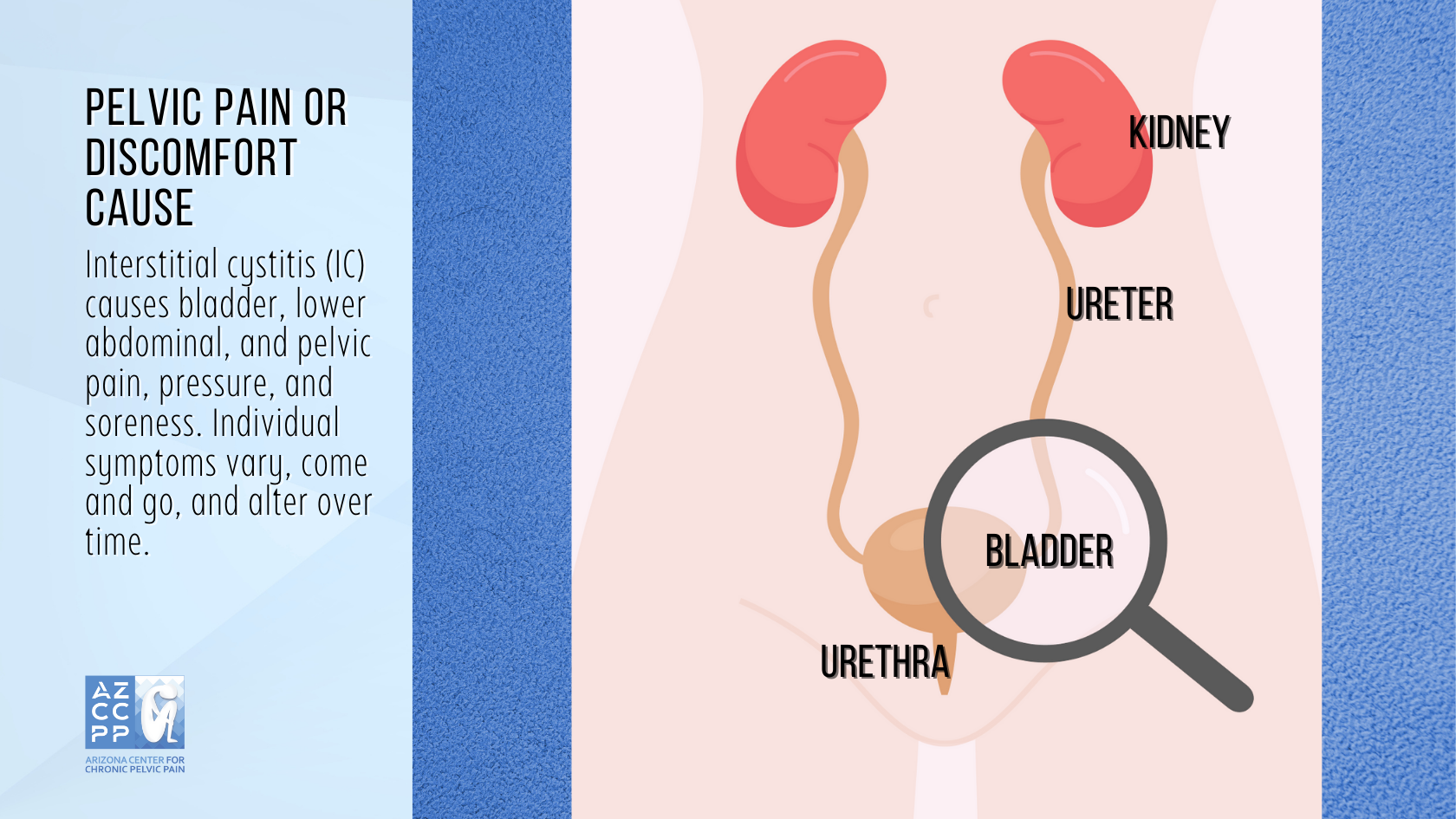 Interstitial Cystitis - Cross Section - Pelvic pain or discomfort cause - AZCCPP