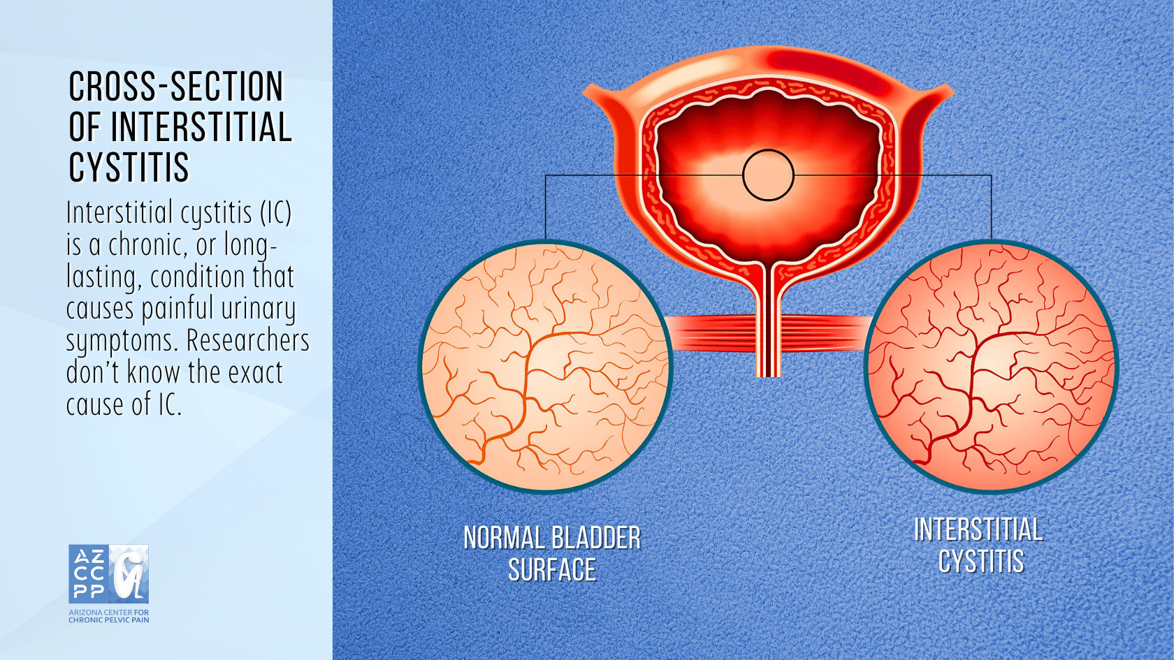 Interstitial Cystitis - cross-section of Interstitial Cystitis - AZCCPP