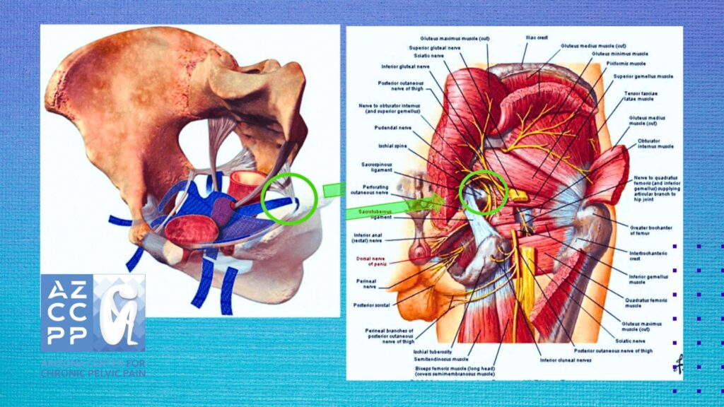 What is Mesh-Related Pain 