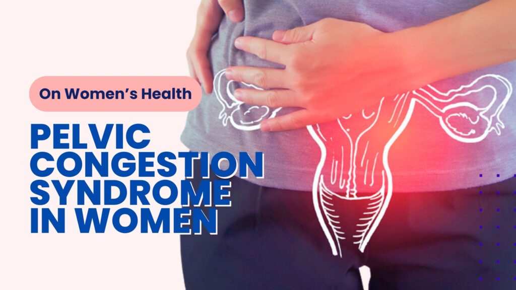 Pelvic Congestion Syndrome in Women 10 Common Questions Answered