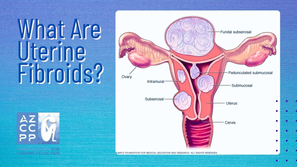 What Are Uterine Fibroids, Myoma, pelvic pain treatment women