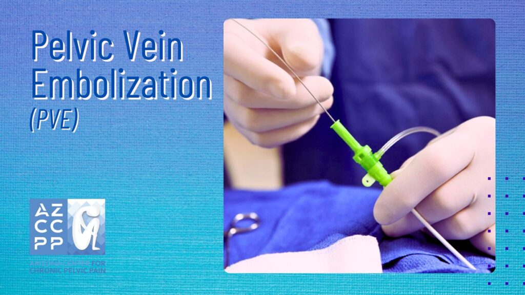 Pelvic Vein Embolization - Emboltherapy - Pelvic Vein Pressure Treatment