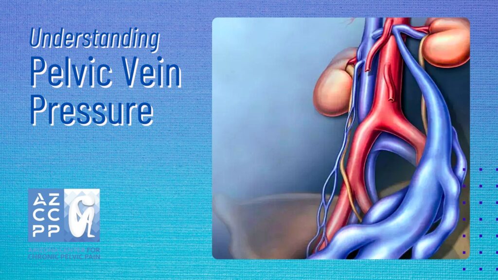 Pelvic Vein Pressure, Emboltherapy, Pelvic Vein Embolization