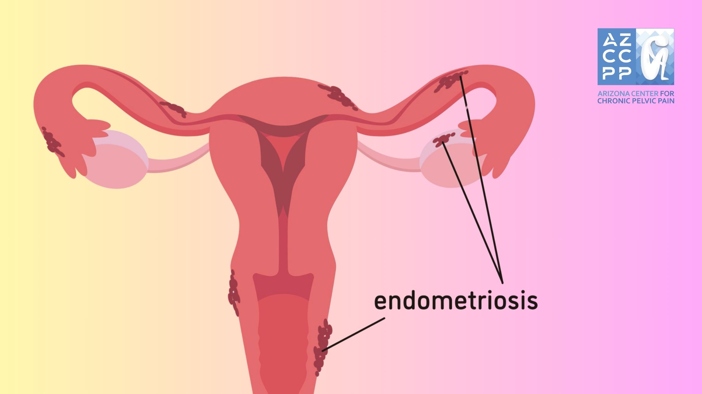 On Women’s Health - Endometriosis and Its Connection to Ovarian Cysts - How Endometriosis Leads to Ovarian Cysts